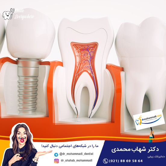 سوالات متداول ایمپلنت - کلینیک دندانپزشکی دکتر شهاب محمدی